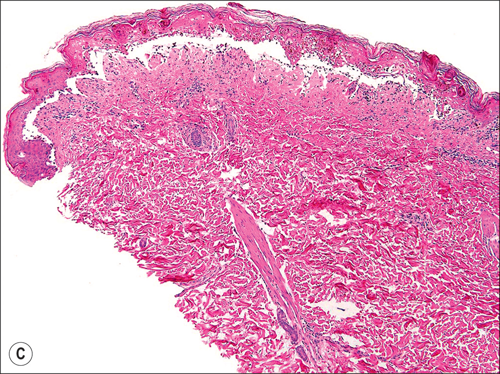 A pair of photographs depicts a cutaneous rash on a patient's body and two microscopic views of a tissue labeled A and B. Panels A and B show a person with numerous blisters on the face and neck. The set of four panels involves two photographs with cutaneous rashes and two microscopic views of rashes labeled A, B, C, and D, arranged in a two-by-two grid. The upper left panel labeled A depicts a photograph of a person lying with a bandage over the eyes, displaying numerous widespread rashes on the surface area of the body. The upper right panel, labeled B, depicts a photograph of the same person with a close-up view of the lesions in the mouth area, illustrating raw, crusted blisters on the lips, cheeks, and surrounding skin. The lower left panel, labeled C, depicts a microscopic view of a tissue with numerous tiny dot-like, cellular structures forming a border in the upper layer. A single multinucleated cell appears in the upper region. A fibrous structure is shown in the middle region. The lower right panel, labeled D, depicts a microscopic view of a tissue with epidermal and dermal layers, highlighting the detachment of the top layer and the presence of numerous round and elongated cellular structures within the lower dermal layer. The middle empty region separates the upper and lower regions. The lower region has nucleated cells that are loosely arranged along the section.