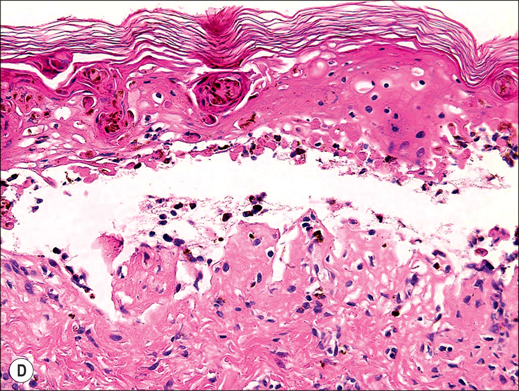 A pair of photographs depicts a cutaneous rash on a patient's body and two microscopic views of a tissue labeled A and B. Panels A and B show a person with numerous blisters on the face and neck. The set of four panels involves two photographs with cutaneous rashes and two microscopic views of rashes labeled A, B, C, and D, arranged in a two-by-two grid. The upper left panel labeled A depicts a photograph of a person lying with a bandage over the eyes, displaying numerous widespread rashes on the surface area of the body. The upper right panel, labeled B, depicts a photograph of the same person with a close-up view of the lesions in the mouth area, illustrating raw, crusted blisters on the lips, cheeks, and surrounding skin. The lower left panel, labeled C, depicts a microscopic view of a tissue with numerous tiny dot-like, cellular structures forming a border in the upper layer. A single multinucleated cell appears in the upper region. A fibrous structure is shown in the middle region. The lower right panel, labeled D, depicts a microscopic view of a tissue with epidermal and dermal layers, highlighting the detachment of the top layer and the presence of numerous round and elongated cellular structures within the lower dermal layer. The middle empty region separates the upper and lower regions. The lower region has nucleated cells that are loosely arranged along the section.