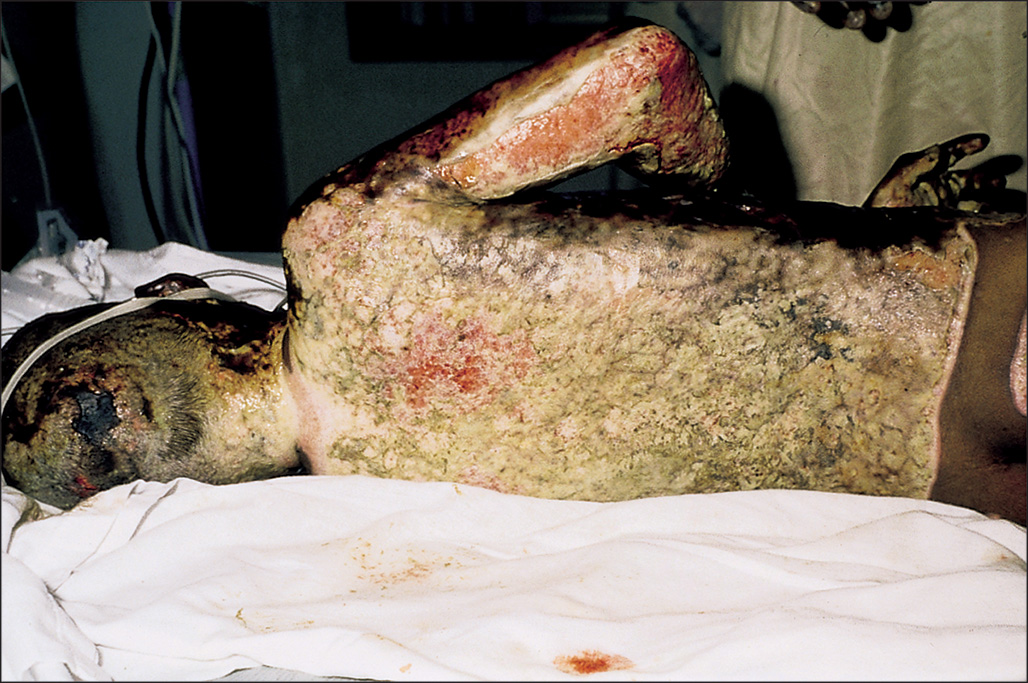 A photograph depicts the dorsal region of a person's head to hip, with severely or completely burnt external skin layer with sepsis, and the patient is positioned laterally on a surface.