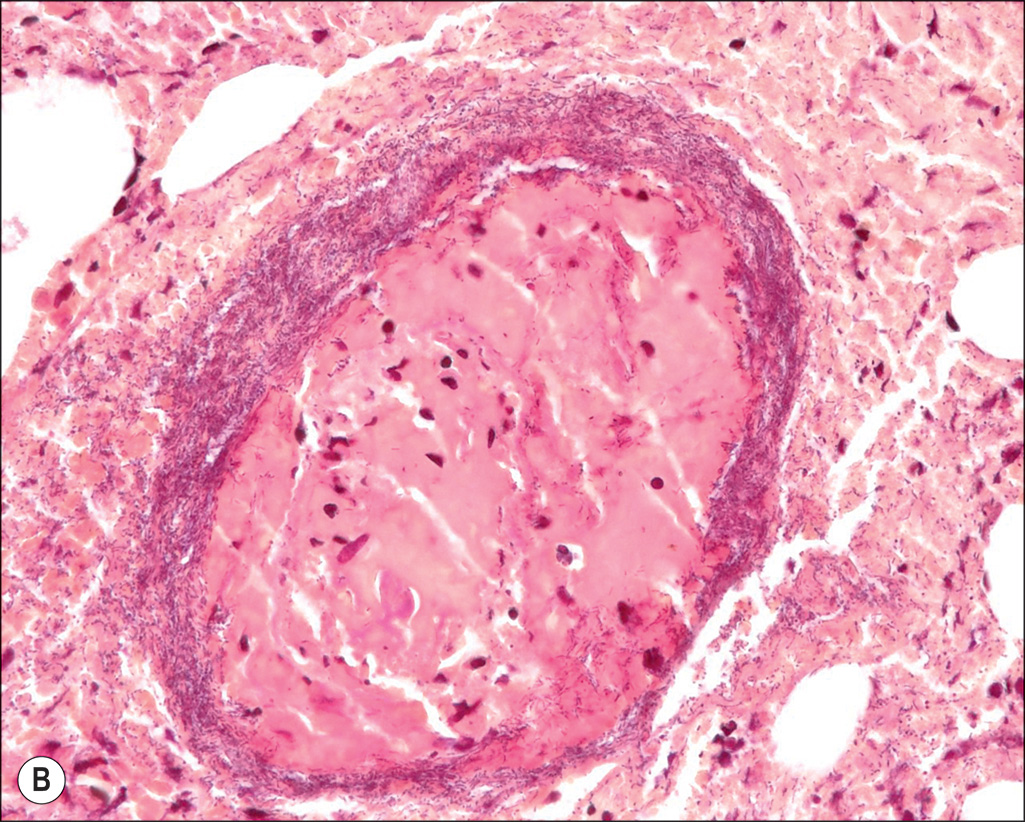 A microscopic view and two photographs are labeled A, B, and C. Part A depicts severely burnt limbs of a child. Part B is a microscopic view of a tissue. Part C depicts a dark lesion near the groin. The three-part layout depicts two photographs and a microscopic view labeled A, B, and C, arranged in two rows. The upper left panel, labeled A, is a photograph that depicts both limbs of a child with severely burnt and infected skin, from the thigh region to the ankle. The patient is positioned laterally. The upper right panel labeled B is a microscopic view of a tissue that depicts an oval-shaped structure extending from the upper middle region to the lower left region. The tissue section depicts a tiny dot-like, numerous cellular structures distributed along the oval region. The upper left region shows a few clear, circular empty cells. The lower right region depicts a single clear cell. The lower left panel labeled C depicts a hairy lower abdominal region with a dark lesion on the skin above the groin.