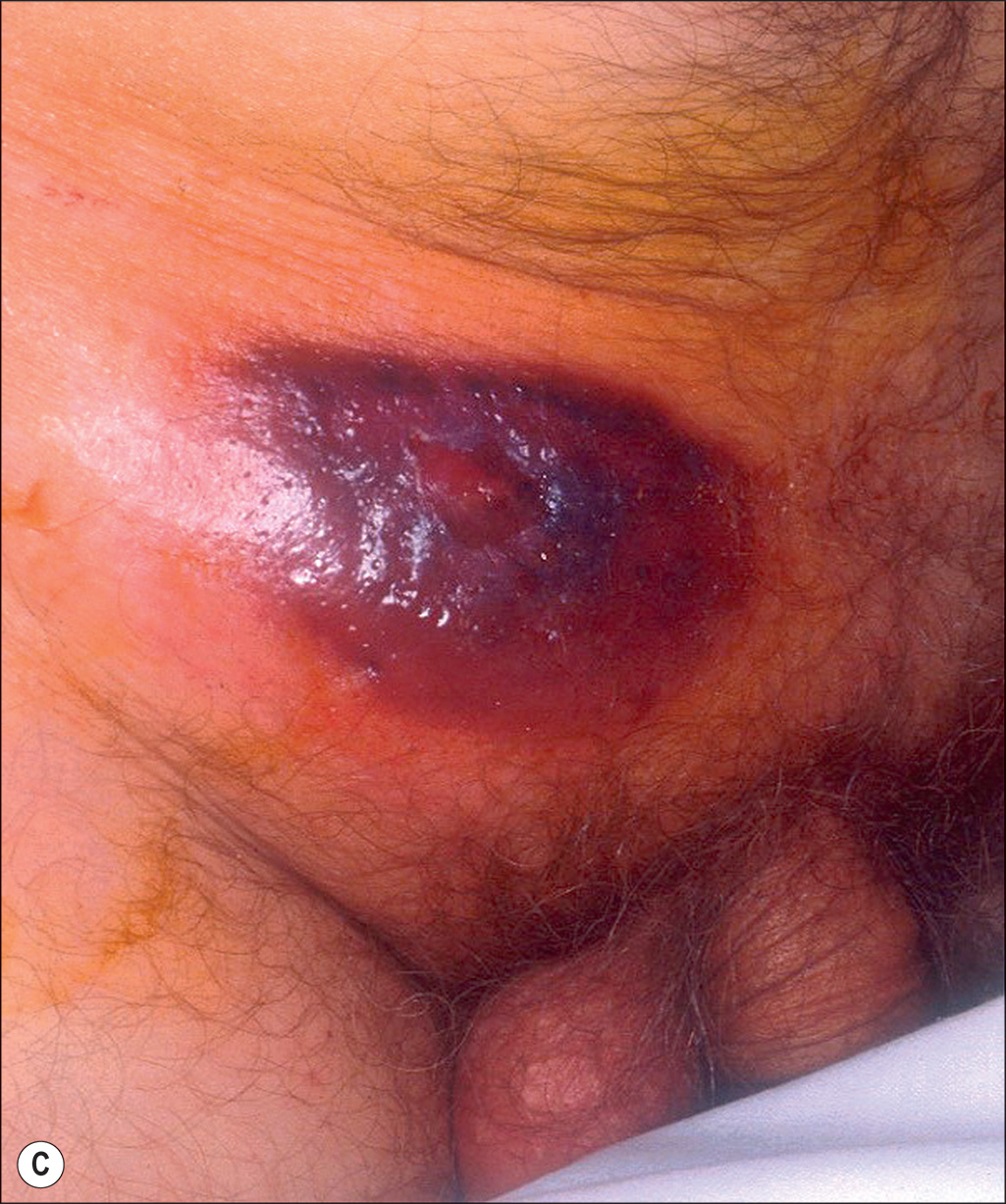 A microscopic view and two photographs are labeled A, B, and C. Part A depicts severely burnt limbs of a child. Part B is a microscopic view of a tissue. Part C depicts a dark lesion near the groin. The three-part layout depicts two photographs and a microscopic view labeled A, B, and C, arranged in two rows. The upper left panel, labeled A, is a photograph that depicts both limbs of a child with severely burnt and infected skin, from the thigh region to the ankle. The patient is positioned laterally. The upper right panel labeled B is a microscopic view of a tissue that depicts an oval-shaped structure extending from the upper middle region to the lower left region. The tissue section depicts a tiny dot-like, numerous cellular structures distributed along the oval region. The upper left region shows a few clear, circular empty cells. The lower right region depicts a single clear cell. The lower left panel labeled C depicts a hairy lower abdominal region with a dark lesion on the skin above the groin.