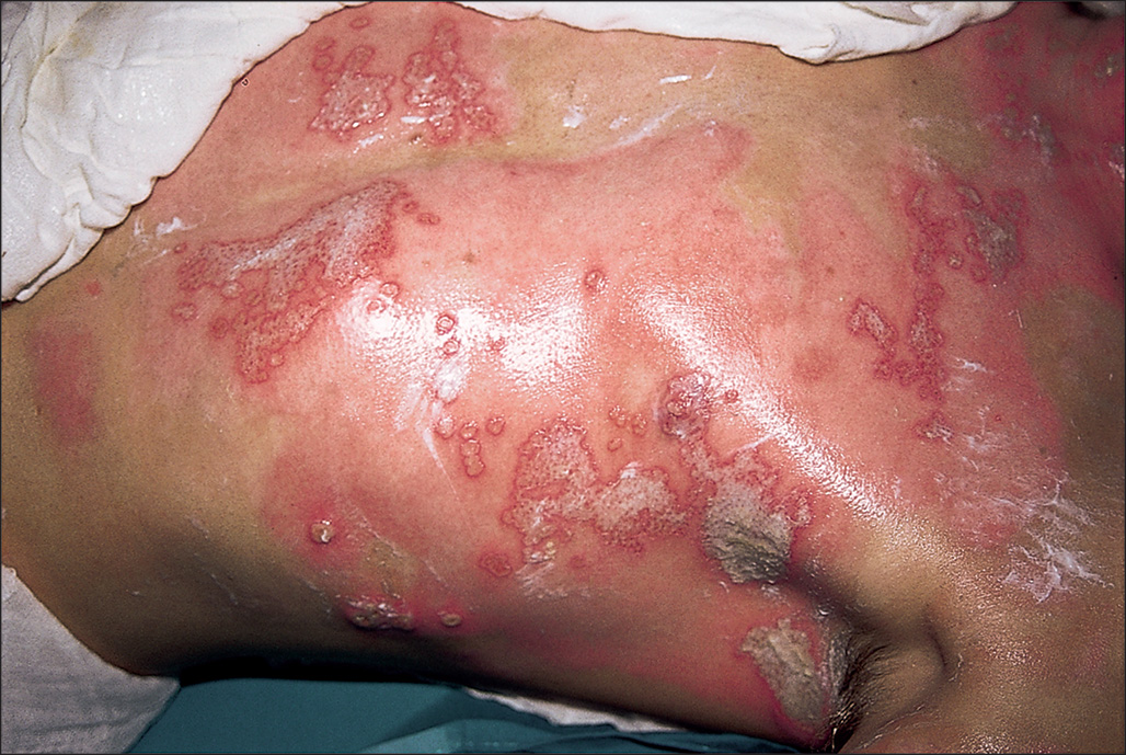 A photograph depicts a person's upper torso. The healing skin surface appears moist and inflamed with large patches of blisters and peeling skin. The photograph depicts the chest and shoulder area, revealing large confluent areas of skin damage with vesicles forming irregular patterns along the borders of the central affected region. Some areas of the skin are covered with a topical substance, and a portion of a surgical bandage covers the right torso of the patient.