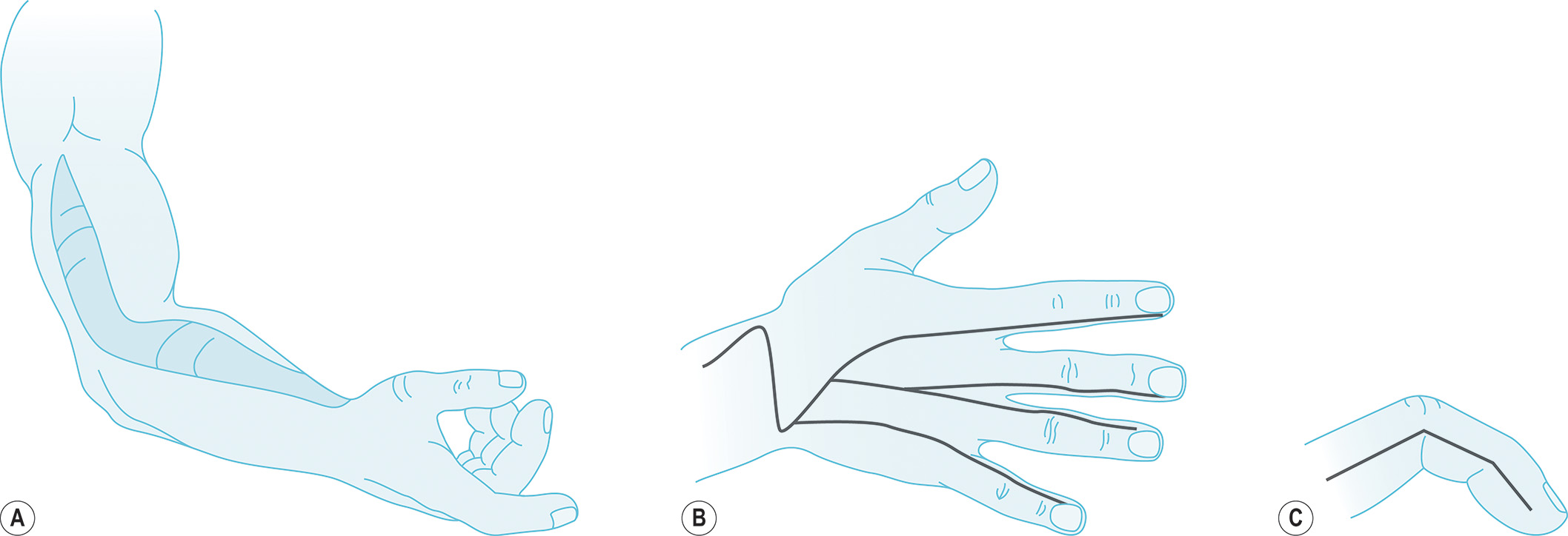 A diagram illustrates a human hand and forearm labeled A, B, and C. Part A depicts an arm with a marked area at the biceps. Part B depicts the palm. Part C depicts the index finger. The set of three diagrams of the human upper limb and hand, labeled A, B, and C. Illustration A focuses on involves arm in a semi-flexed position, highlighting the contours of the muscles and bones beneath the skin from the biceps to the forearm. Illustration B presents hand and spread out fingers, with a line marked, tracing a path that starts at the wrist area, crosses the palm in an M-shaped pattern, and continues to the tips of the fingers. Illustration C provides a side profile of the distal portion of a finger, which is bent downward at the distal and proximal interphalangeal joints, with a line marked along the finger.