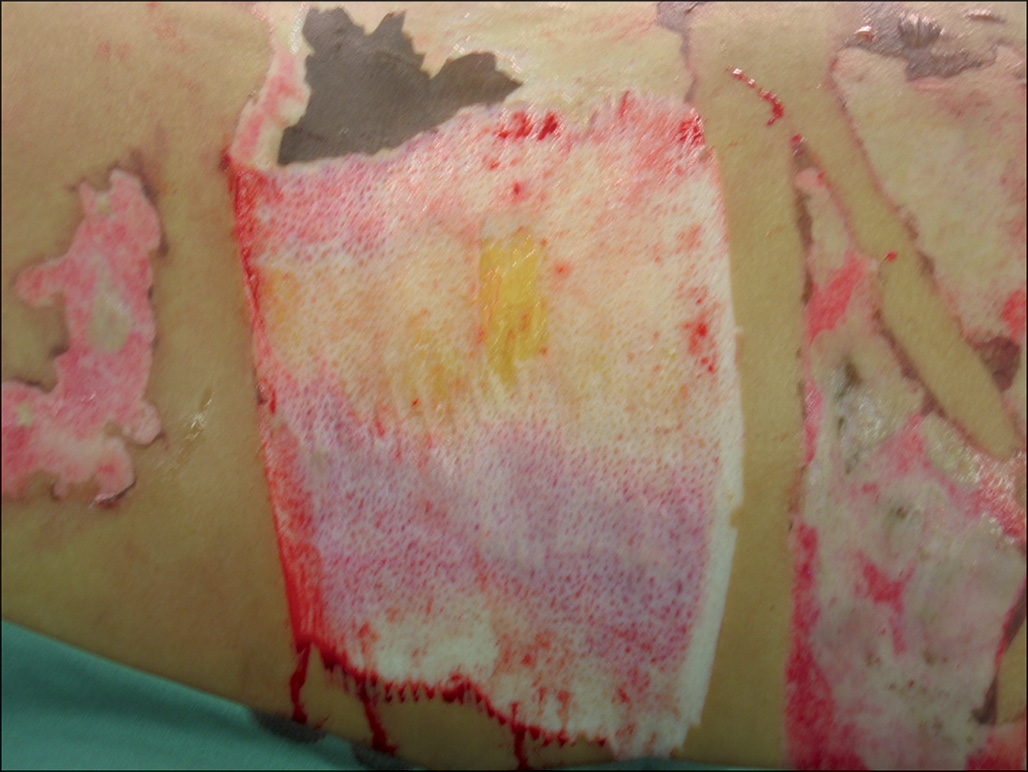 A capture of the burnt left thigh region presents a large, raw area with an exposed dermal layer. The surrounding skin is peeled in several places with swollen borders.