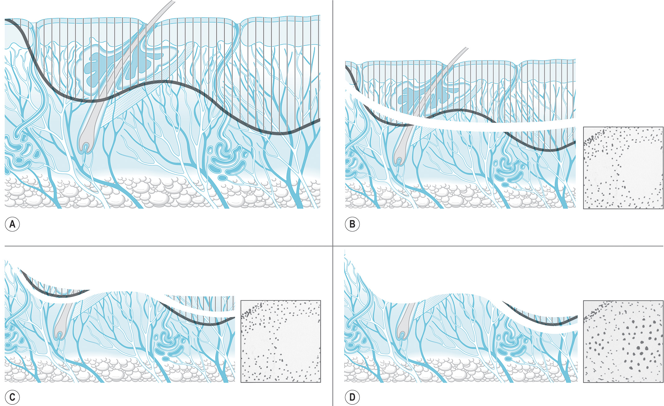 A schematic representation of four sequential excisions of a skin surface, labeled A to D. Each part shows a cross-section of tissue with a dark curved line indicating a plane of incision. The schematic representation presents four diagrams arranged in a two-by-two grid that depict the sequential removal of tissue layers. Diagram A illustrates the dermal layers of the skin with the incision plane marked near the surface. Diagram B illustrates a slice of tissue removed above the incision plane, revealing a slightly deeper level of the structure, and a small inset square with a few scattered dots and two clear, large empty spaces on the left and right sides of the section. Diagram C illustrates a second, deeper slice removed, and the associated inset square now contains more scattered dots than the previous stage. Diagram D illustrates the deepest level, where the plane of incision is now close to the base of the structure, and the final inset square contains numerous, distinct dots scattered uniformly across the section.