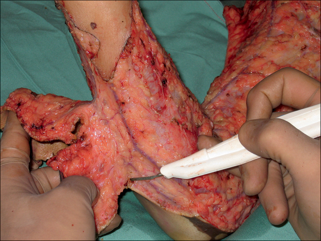 An intraoperative photograph shows a surgical procedure on the right forearm. The gloved hand holds an instrument to incise the underside of the raised tissue flap. The intraoperative photograph presents a cut-opened region of the forearm, which is held by a gloved hand on the left. The surgical instrument held by a gloved hand is involved in the procedure. The upper portion of the tissue depicts traces of superficial skin remaining, and the deeper layers of the tissue are exposed.