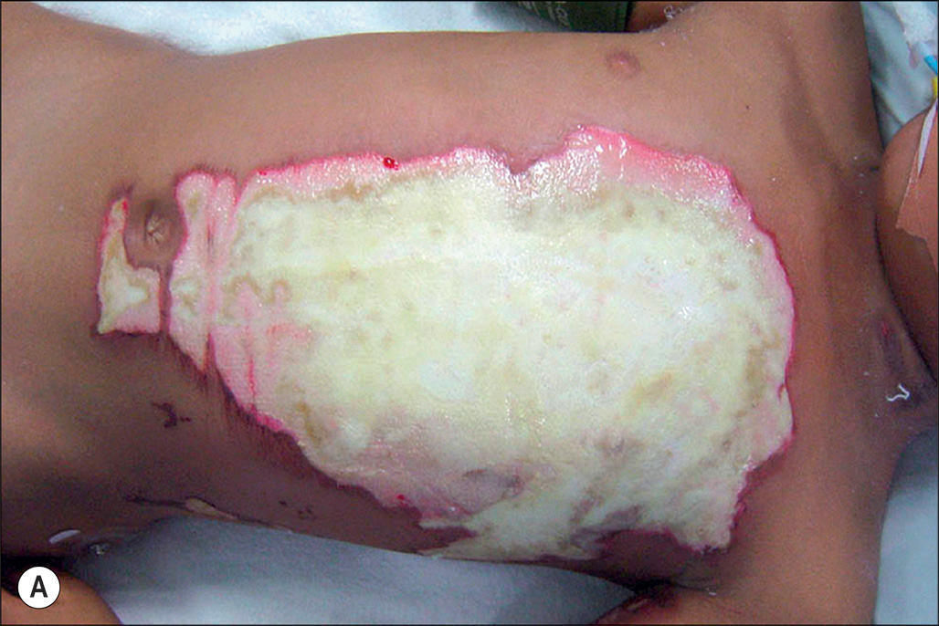 A set of five photos of the medical procedure of a child's chest with deep flame burn on the torso, labeled A to E. Panels A to D depict raw, damaged skin, wound wrapped with transparent material. The set of five photographs labeled A through E involves a medical procedure on a child's chest due to a deep flame burn. Photograph A involves a patient lying on a surface with a large area of damaged tissue on the torso. Photograph B presents the same area after excision, revealing a raw, underlying layer of the skin. Photograph C presents a large, oval-shaped dressing applied to the torso area, which appears dark and is connected to a tube. The wound is completely wrapped with a transparent material. Photograph D depicts a gloved hand holding a surgical forceps, lifting a thin, transparent silicone outer layer away from the treated area, revealing the underlying granular surface. The final photograph, E, depicts the patient, with their eyes obscured by a bar, presenting the chest and upper abdomen, where the treated area with a large, flat, irregularly shaped patch of healed skin.