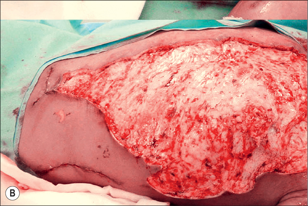 A set of five photos of the medical procedure of a child's chest with deep flame burn on the torso, labeled A to E. Panels A to D depict raw, damaged skin, wound wrapped with transparent material. The set of five photographs labeled A through E involves a medical procedure on a child's chest due to a deep flame burn. Photograph A involves a patient lying on a surface with a large area of damaged tissue on the torso. Photograph B presents the same area after excision, revealing a raw, underlying layer of the skin. Photograph C presents a large, oval-shaped dressing applied to the torso area, which appears dark and is connected to a tube. The wound is completely wrapped with a transparent material. Photograph D depicts a gloved hand holding a surgical forceps, lifting a thin, transparent silicone outer layer away from the treated area, revealing the underlying granular surface. The final photograph, E, depicts the patient, with their eyes obscured by a bar, presenting the chest and upper abdomen, where the treated area with a large, flat, irregularly shaped patch of healed skin.