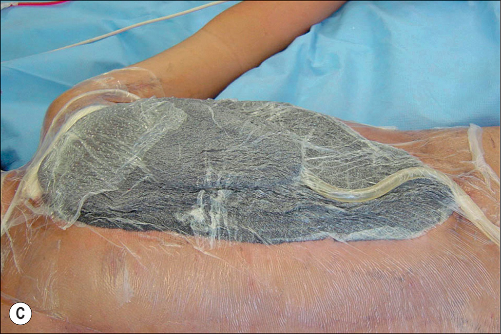 A set of five photos of the medical procedure of a child's chest with deep flame burn on the torso, labeled A to E. Panels A to D depict raw, damaged skin, wound wrapped with transparent material. The set of five photographs labeled A through E involves a medical procedure on a child's chest due to a deep flame burn. Photograph A involves a patient lying on a surface with a large area of damaged tissue on the torso. Photograph B presents the same area after excision, revealing a raw, underlying layer of the skin. Photograph C presents a large, oval-shaped dressing applied to the torso area, which appears dark and is connected to a tube. The wound is completely wrapped with a transparent material. Photograph D depicts a gloved hand holding a surgical forceps, lifting a thin, transparent silicone outer layer away from the treated area, revealing the underlying granular surface. The final photograph, E, depicts the patient, with their eyes obscured by a bar, presenting the chest and upper abdomen, where the treated area with a large, flat, irregularly shaped patch of healed skin.