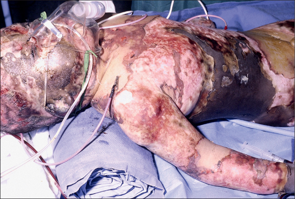 A photograph shows a child lying on an operating table with major skin burns around the head, chest, and right arm. The patient has nasal tubes and intravenous tubes inserted to the body. The photograph is a close-up view of a child’s upper torso and head, with severely burnt skin layers. An endotracheal tube extends from the mouth and is secured over the head, and multiple other intravenous fluid lines run over the chest and arm, connecting the patient to external medical equipment. The patient lies on a surface covered by surgical cloth.