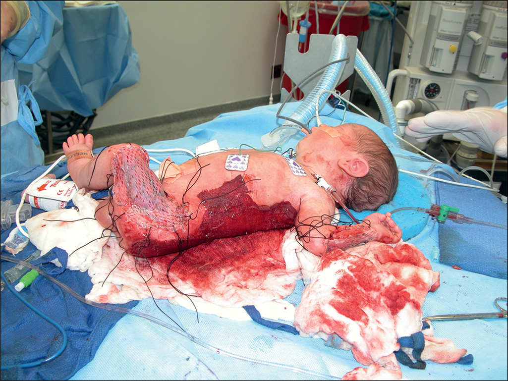 A capture depicts a child lying on an operating table with extensive skin injury. The tissue from the legs and lower torso has tubings, and sutures placed. Severe blood loss is observed. The photograph captures a child positioned on an operating table with multiple monitoring wires attached to the chest and abdomen. The skin is injured from a large area of the lower torso, thighs, and buttocks, exposing deep tissue. The right hand and arm also show areas of exposed tissue. A collection of tissue and fluid is visible near the patient's left hip, and various tubing and monitoring devices are present near the patient's head and right side.