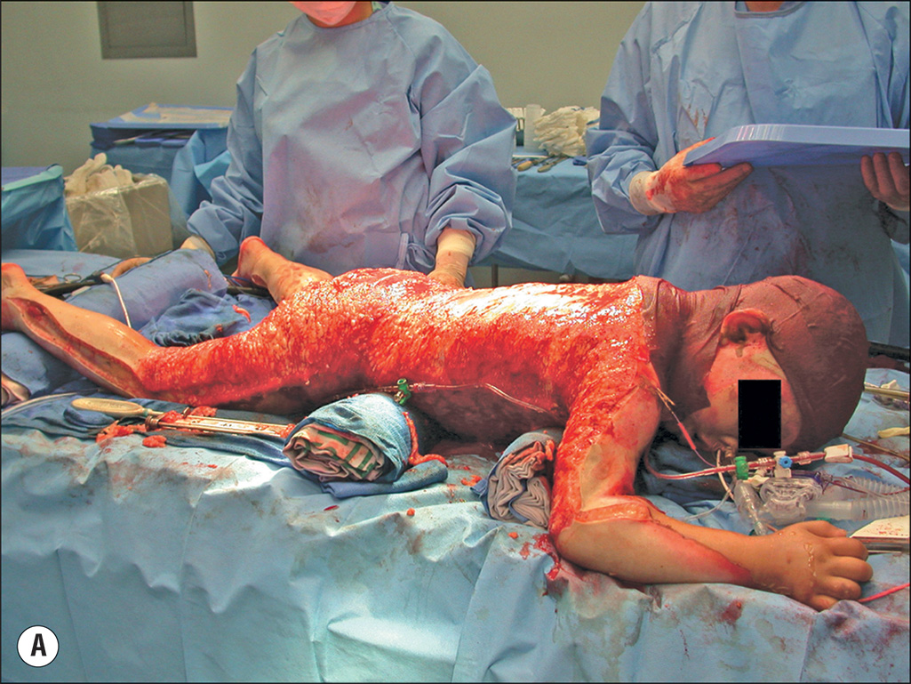 A pair of photos labeled A and B. A depicts a child on an operating table with extensive skin layer damage and two surgeons beside the table. B depicts a close view of an excision made on the skin. The two photographs illustrate different surgical fields during an operation. Photograph A depicts a child in prone position on a surgical drape, arms, and legs showing tissue that is raw and bleeding. The child's head is obscured, and numerous tubes and wires are present around the upper body and arms, with two surgeons standing beside the table. Photograph B presents an incision made on the vertebral region and the gloved hand holding the skin excision with forceps on the right side.