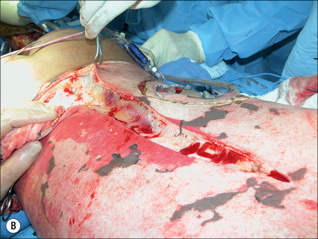 A pair of photos labeled A and B. A depicts a child on an operating table with extensive skin layer damage and two surgeons beside the table. B depicts a close view of an excision made on the skin. The two photographs illustrate different surgical fields during an operation. Photograph A depicts a child in prone position on a surgical drape, arms, and legs showing tissue that is raw and bleeding. The child's head is obscured, and numerous tubes and wires are present around the upper body and arms, with two surgeons standing beside the table. Photograph B presents an incision made on the vertebral region and the gloved hand holding the skin excision with forceps on the right side.