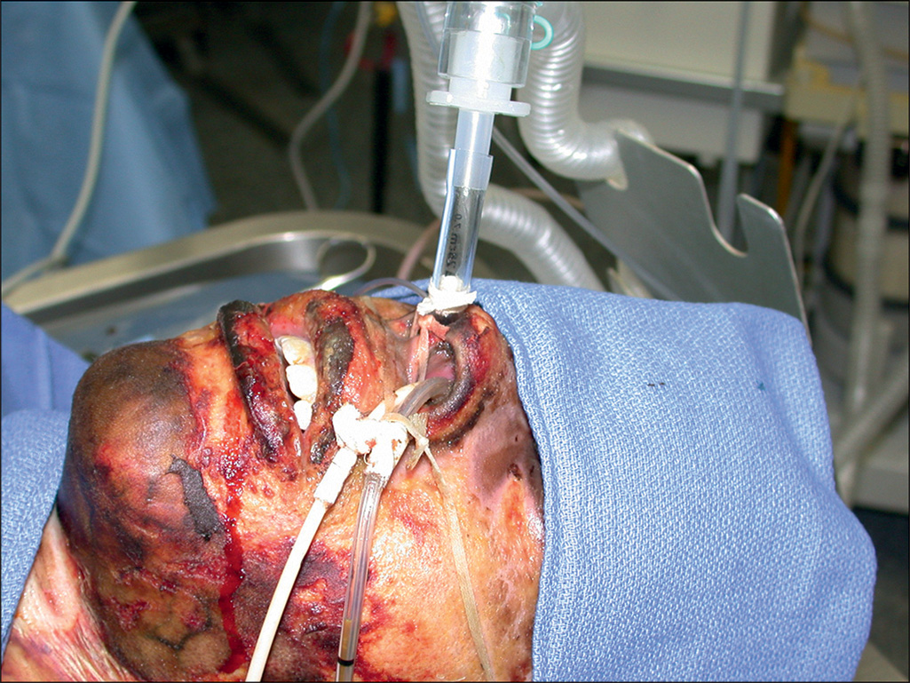 A photograph depicts a patient's head and face with severe injuries and multiple endotracheal tubes inserted into the nasal region. The burnt wounds are present on the face and neck.