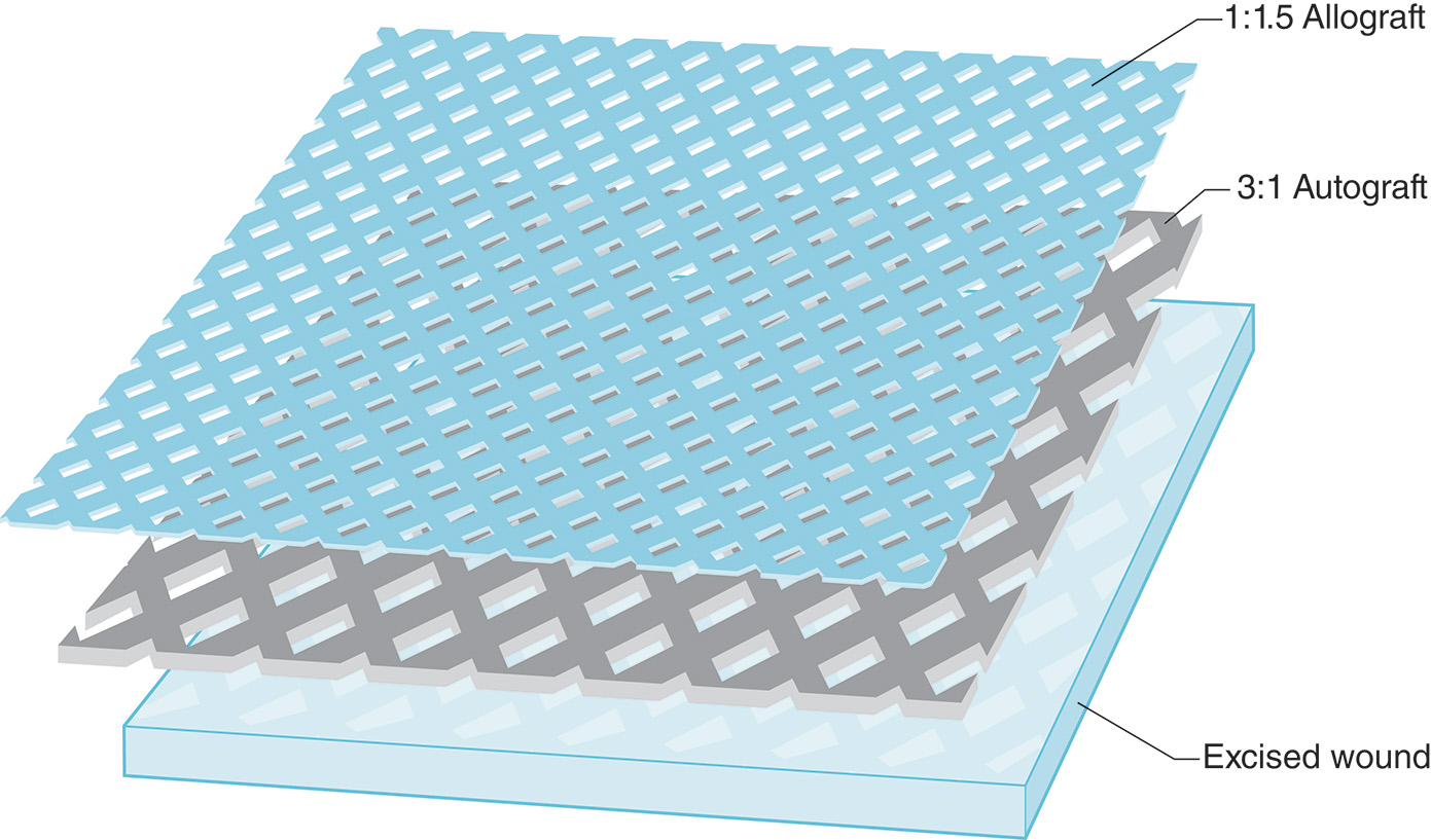A diagram depicting the meshed allograft overlay technique for burn treatment, with labels for the allograft, autograft, and excised wound. The diagram depicts a burn wound labeled as the excised wound. The patient’s own skin, labeled autograft, is meshed and placed over the wound. On top of this, a donor skin layer, labeled allograft, is meshed and overlaid. The diagram highlights the arrangement of the excised wound at the bottom, the 3:1 autograft in the middle, and the 1:1.5 allograft on top.