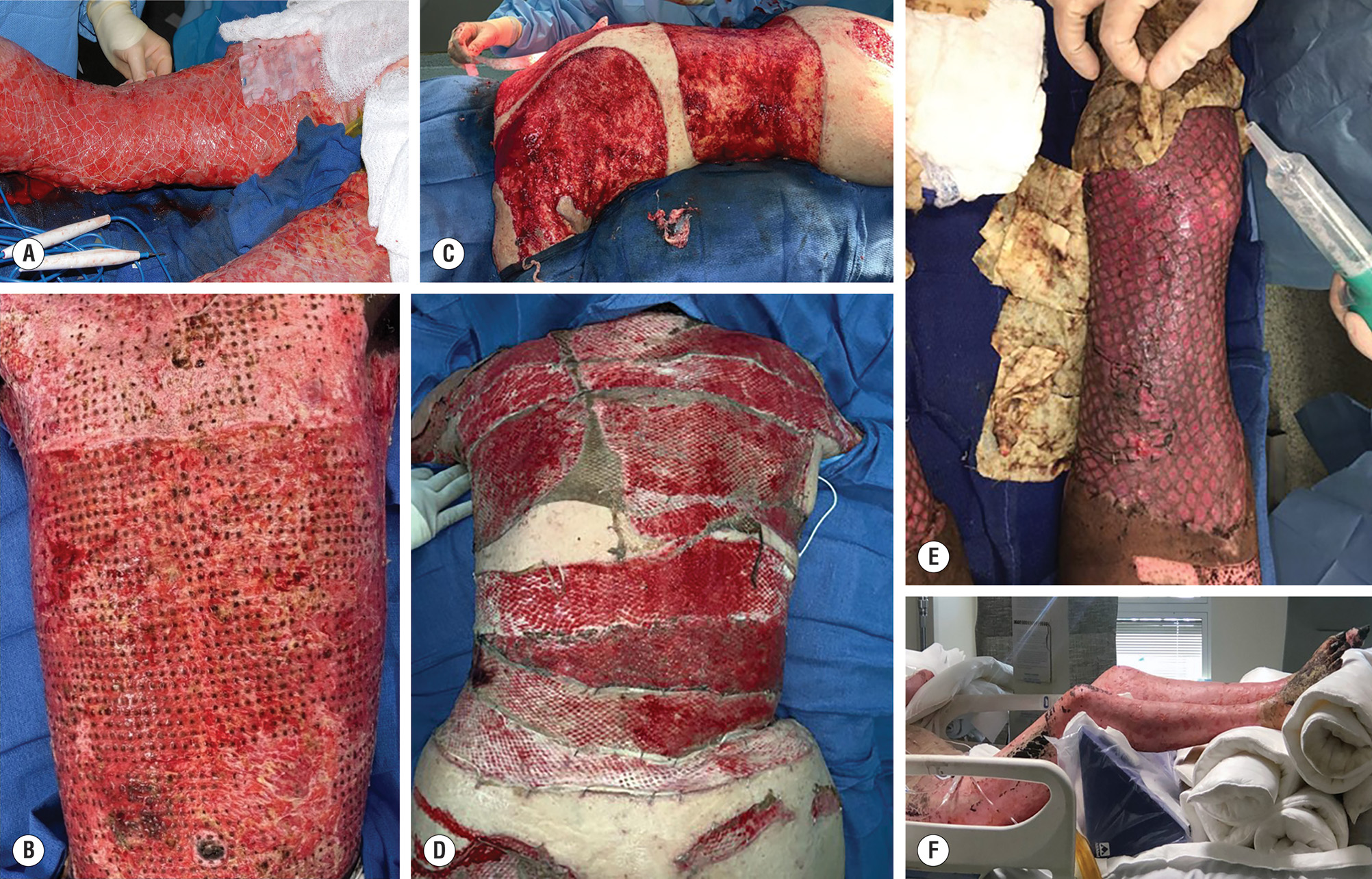 A six-part photographs showing different phases of burn wound treatment, from mesh and Meek grafting to wound cleaning, cadaver graft healing, and cultured skin application and drying. The six-part photographs show the step-by-step treatment of a patient with large full-thickness burns. Image A shows a wound covered with a widely meshed autograft that looks like a stretched net over raw skin. Image B shows multiple small square Meek autografts placed evenly across the wound surface. Image C shows a freshly cleaned wound bed with exposed red tissue where AlloDerm is being placed. Image D shows a healing wound covered with an engrafted cadaver graft that appears smooth and pink, indicating a well-vascularized bed. Image E shows the cultured epidermal autograft being gently removed or checked, with fragile new skin visible underneath. Image F shows the final stage where the area with the cultured epidermal autograft is being aired and allowed to dry, giving a thin, delicate skin-like appearance