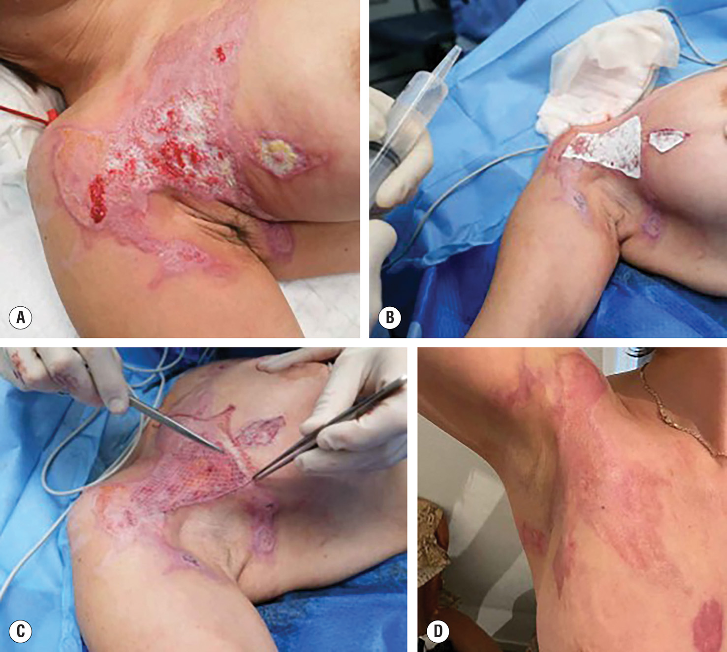 A four-part photograph shows the healing process of a severe burn on a patient’s arm. The image A shows the burn with damaged and raw skin. Image B shows the wound after removal of dead tissue and placement of healthy new skin tissue. Image C shows a thin, meshed skin graft covering the wound, stretched to maximum its size. Image D shows the arm with healed skin, showing significant improvement and coverage of the previously burned area.