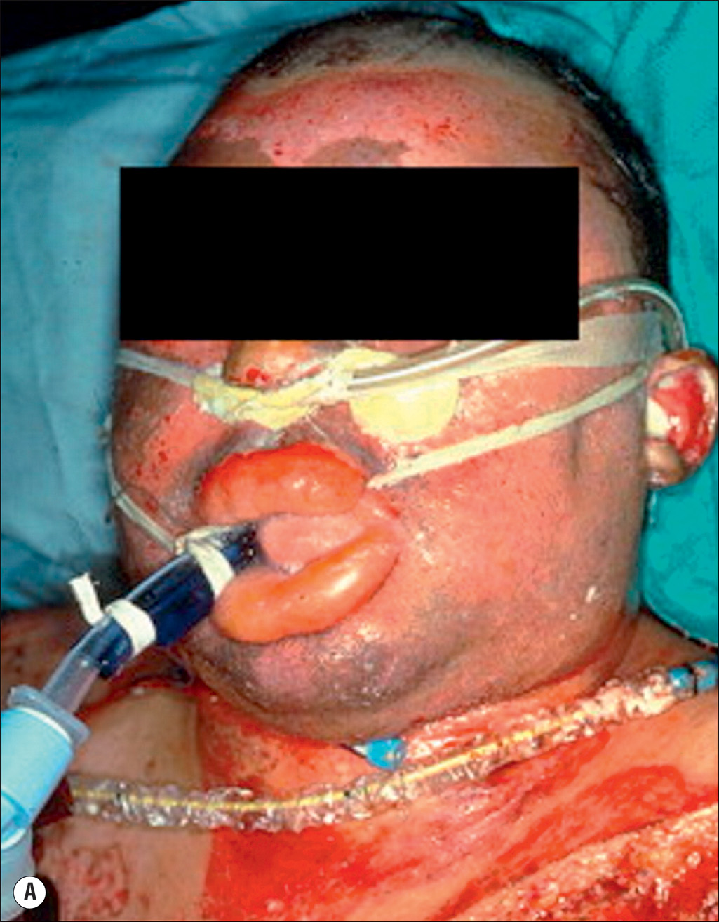 A three-part image showing facial burns, swollen lips with airway tubes, redness inside the airway, and a dark airway blockage. The first image A depicts a person with burns on the face. The lips are swollen. A tube is inserted into the mouth. Thin air tubes are placed in the nose. Pipes are also inserted into the neck. Red patches are visible on the ears and neck. The second image B depicts the inside of the airway. The lining is red and swollen. The third image C depicts a blockage forming inside the airway. The blockage is dark in color.