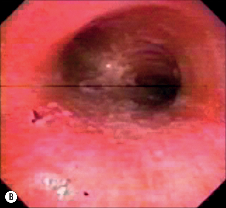 A three-part image showing facial burns, swollen lips with airway tubes, redness inside the airway, and a dark airway blockage. The first image A depicts a person with burns on the face. The lips are swollen. A tube is inserted into the mouth. Thin air tubes are placed in the nose. Pipes are also inserted into the neck. Red patches are visible on the ears and neck. The second image B depicts the inside of the airway. The lining is red and swollen. The third image C depicts a blockage forming inside the airway. The blockage is dark in color.