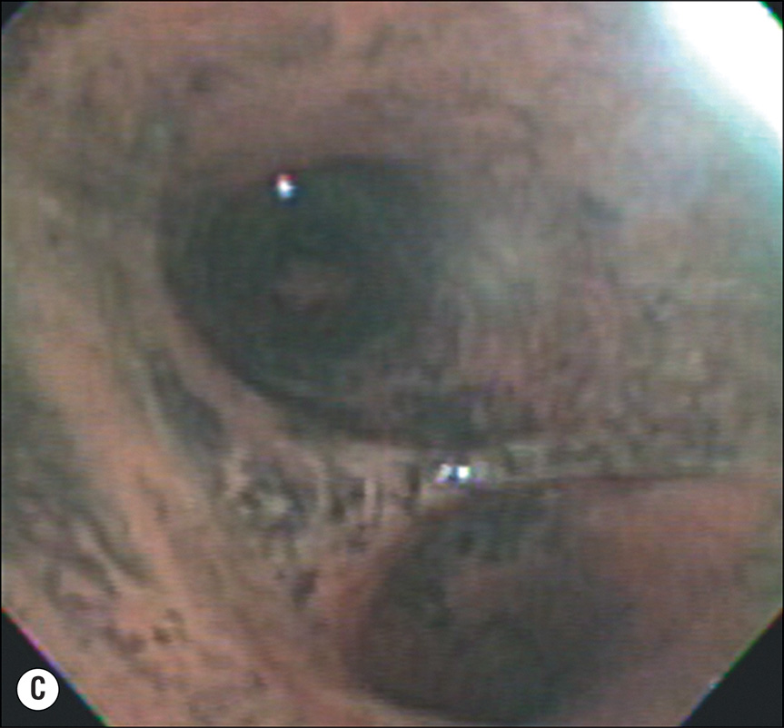 A three-part image showing facial burns, swollen lips with airway tubes, redness inside the airway, and a dark airway blockage. The first image A depicts a person with burns on the face. The lips are swollen. A tube is inserted into the mouth. Thin air tubes are placed in the nose. Pipes are also inserted into the neck. Red patches are visible on the ears and neck. The second image B depicts the inside of the airway. The lining is red and swollen. The third image C depicts a blockage forming inside the airway. The blockage is dark in color.