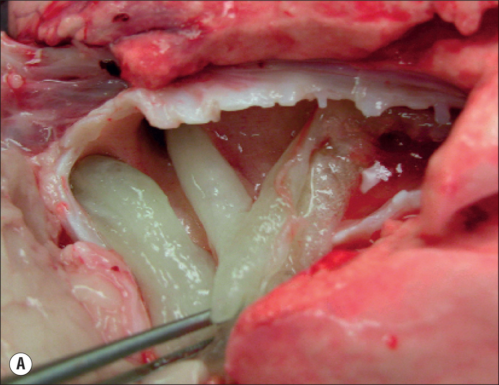 A four-part image showing airway blockages after burn and smoke injury. The image A shows a long, bright tube-shaped cast from a sheep’s airway. Image B shows an elongated tube-shaped cast marked 5 centimeters. Image C is a microscopic image showing round or oval airways filled with irregularly shaped blockages. Image D shows a small airway fully blocked by dark, thick, sticky mucus.