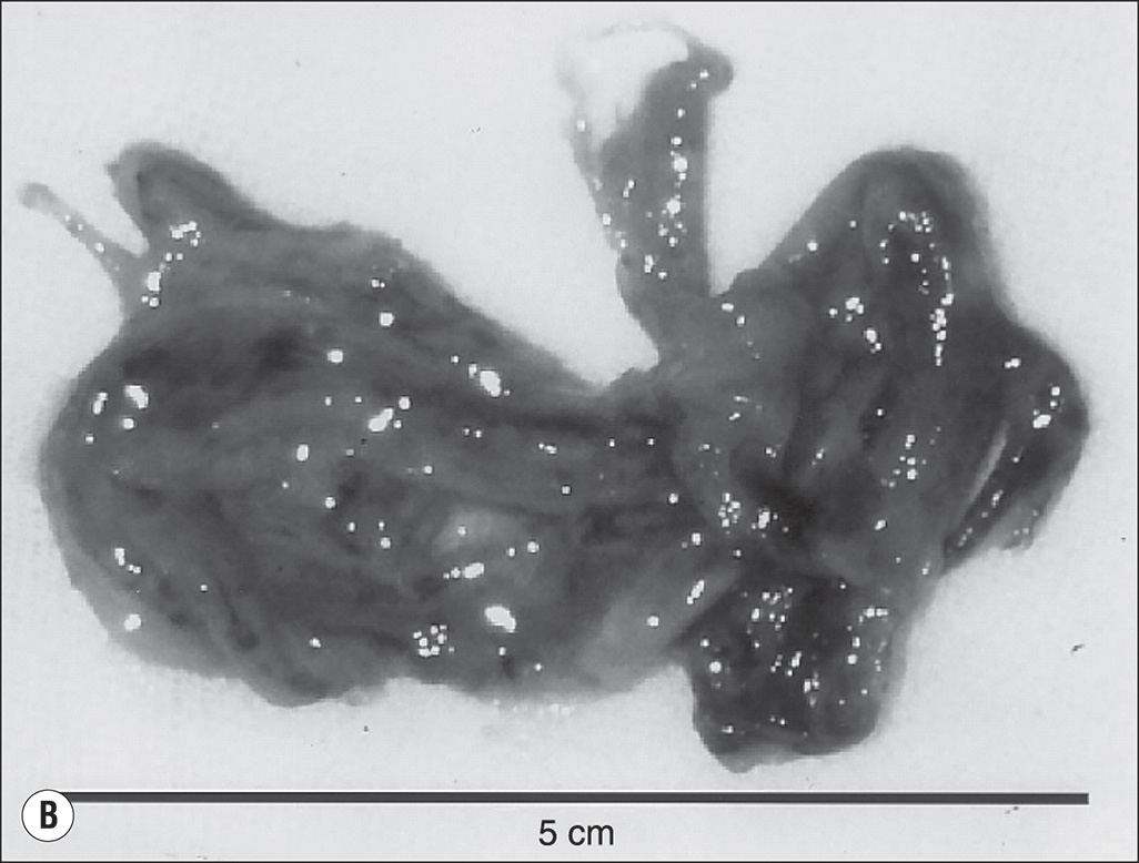 A four-part image showing airway blockages after burn and smoke injury. The image A shows a long, bright tube-shaped cast from a sheep’s airway. Image B shows an elongated tube-shaped cast marked 5 centimeters. Image C is a microscopic image showing round or oval airways filled with irregularly shaped blockages. Image D shows a small airway fully blocked by dark, thick, sticky mucus.