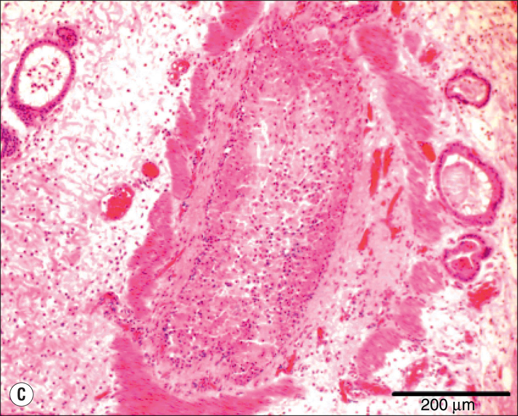 A four-part image showing airway blockages after burn and smoke injury. The image A shows a long, bright tube-shaped cast from a sheep’s airway. Image B shows an elongated tube-shaped cast marked 5 centimeters. Image C is a microscopic image showing round or oval airways filled with irregularly shaped blockages. Image D shows a small airway fully blocked by dark, thick, sticky mucus.