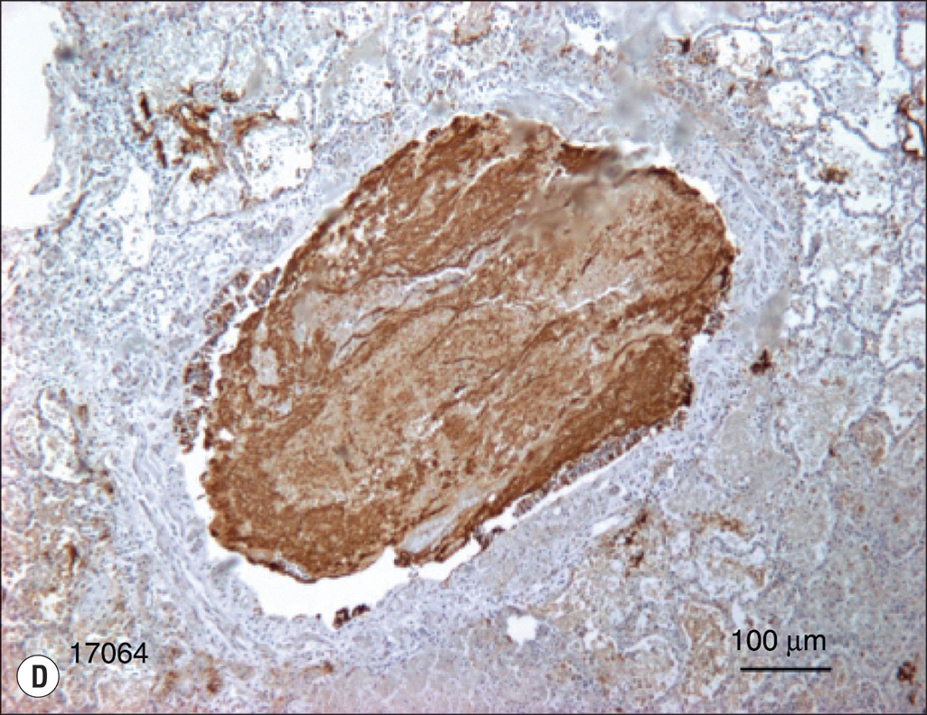 A four-part image showing airway blockages after burn and smoke injury. The image A shows a long, bright tube-shaped cast from a sheep’s airway. Image B shows an elongated tube-shaped cast marked 5 centimeters. Image C is a microscopic image showing round or oval airways filled with irregularly shaped blockages. Image D shows a small airway fully blocked by dark, thick, sticky mucus.