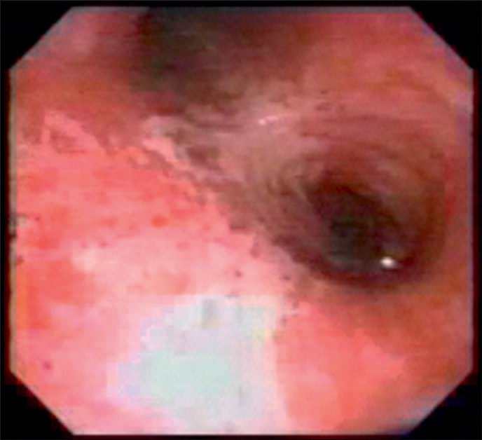 A bronchoscopic view of the trachea showing swollen, red tissue with blurred rings, patchy damaged lining, and fibrin coating where the airway splits.
