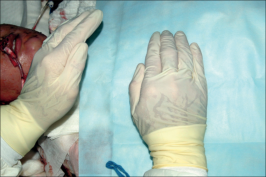 A healthcare professional presses the patient’s chest with both hands, chest covered with a translucent cloth, patient lying on bed with a breathing tube in the nose.