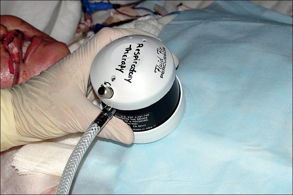 A handheld percussor is placed above the patient’s chest. The patient is lying with a breathing tube inserted in the nose.