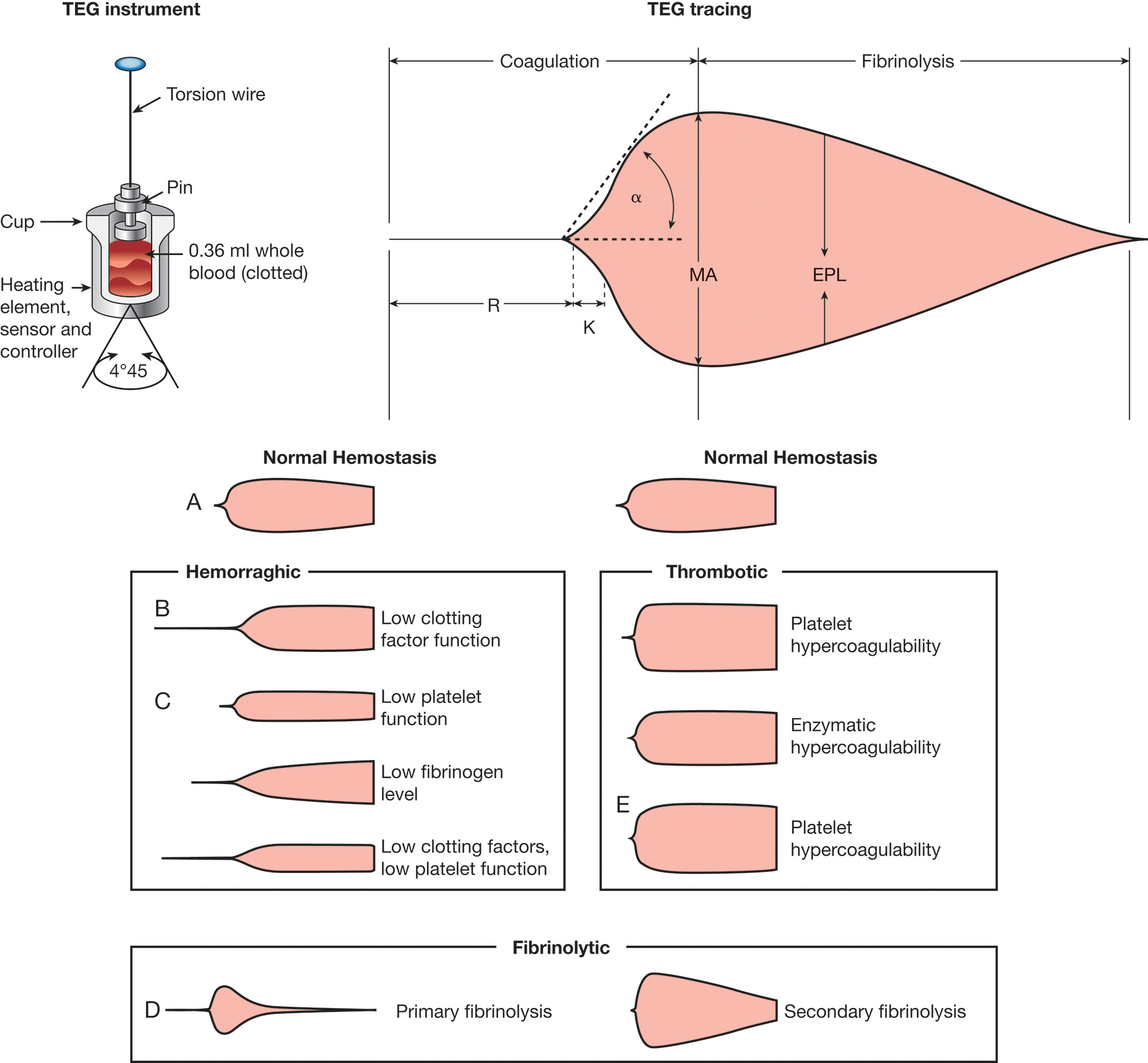 An illustration of a T E G instrument and its components, along with TEG tracings and their interpretations. The T E G instrument consists of a cup, pin, a torsion wire, and a heating element with a sensor and controller. A small volume of whole blood, zero point three six milliliters, is placed in the cup, which clots to assess coagulation and fibrinolysis. The cup twists at an angle of four degrees forty-five minutes. The T E G tracing depicts different patterns representing normal hemostasis, hemorrhagic, thrombotic, and fibrinolytic conditions. Key T E G parameters include R, located in the coagulation phase, K, and E P L, marked in the fibrinolysis phase. The tracing appears as two oppositely pointed cone-shaped structures. Tracing A represents normal hemostasis. Tracing B depicts hemorrhagic patterns with low clotting factor function. Tracing C depicts low platelet function, low fibrinogen levels, and low clotting factor activity. Thrombotic patterns reflect platelet hypercoagulability and enzymatic hypercoagulability, with tracing E indicating platelet hypercoagulability. Fibrinolytic patterns are shown in tracing D, depicting primary and secondary fibrinolysis.