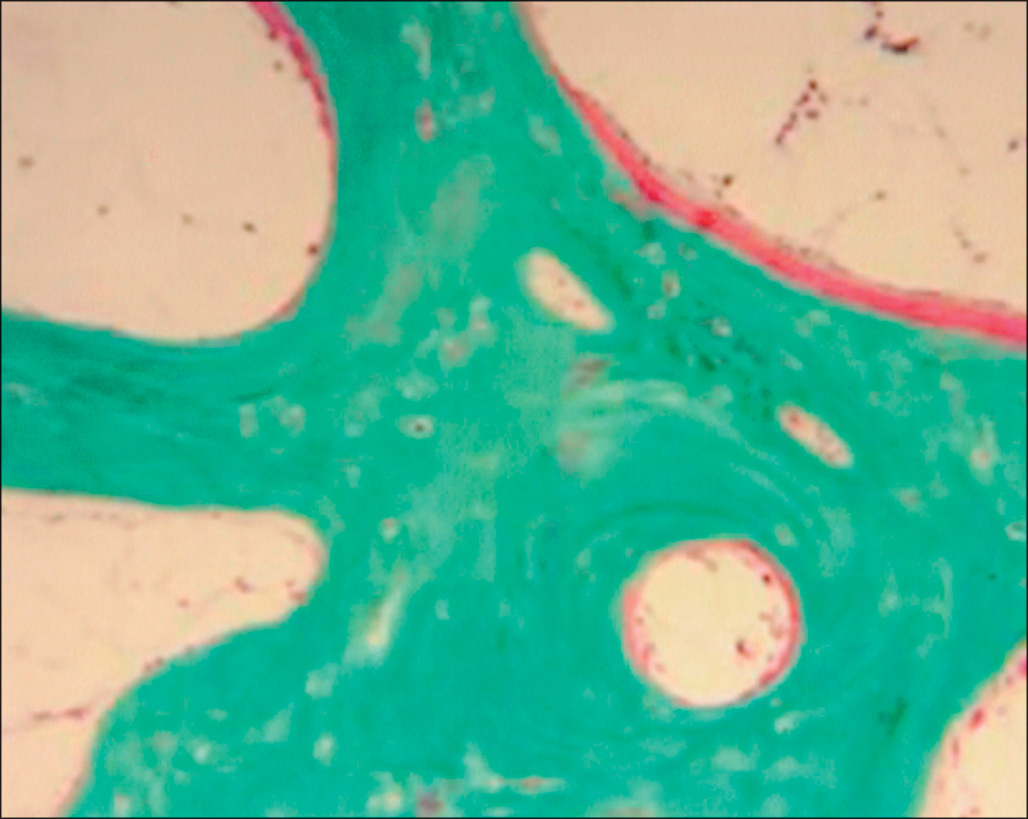A bone sample from the hip shows hard, fully formed bone and softer, newly made bone tissue. Thin, elongated cells along the new bone surface are bone-building cells.