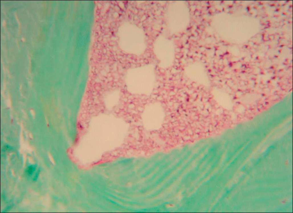 A bone biopsy from a burned patient shows hard, mineralized bone with absent bone-building cells along the surface.