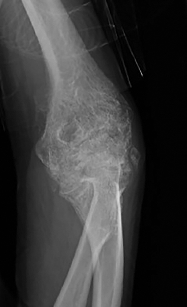 An X-ray showing extra, irregular bone forming around the elbow joint after a burn injury.