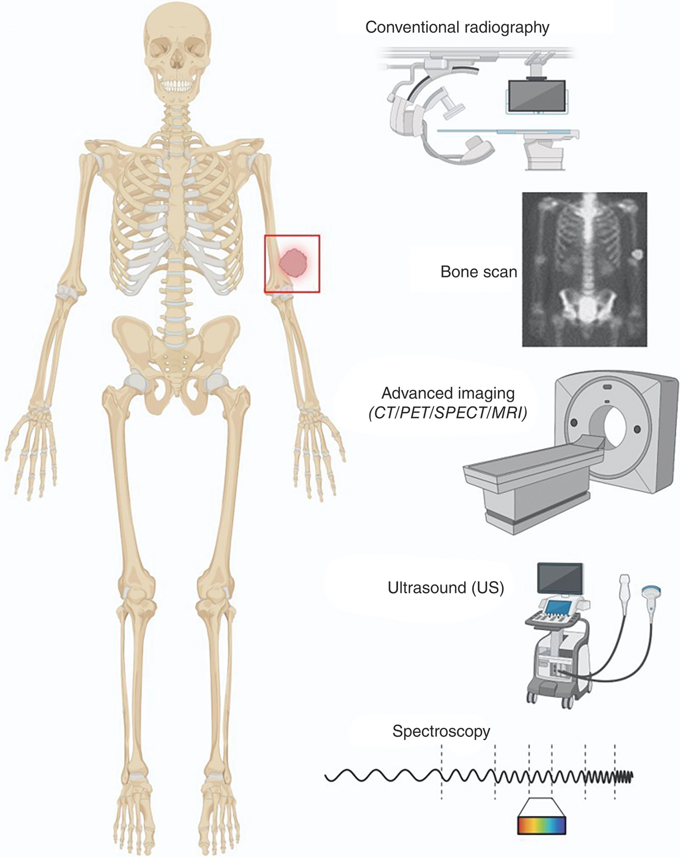 An anterior skeleton view highlighting extra bone growth at the humerus, with diagnostic instruments and imaging techniques used to assess it. The anterior view of the skeleton highlights extra bone growth at the end of the humerus, marked by a square box. This abnormal bone formation is evaluated using several diagnostic methods: conventional radiography, bone scans, and advanced imaging techniques such as C T or P E T or S P E C T, or M R I, which are performed using machines with a patient bed and round scanning component. Ultrasound machines and spectroscopy are also used to assess the heterotopic bone.