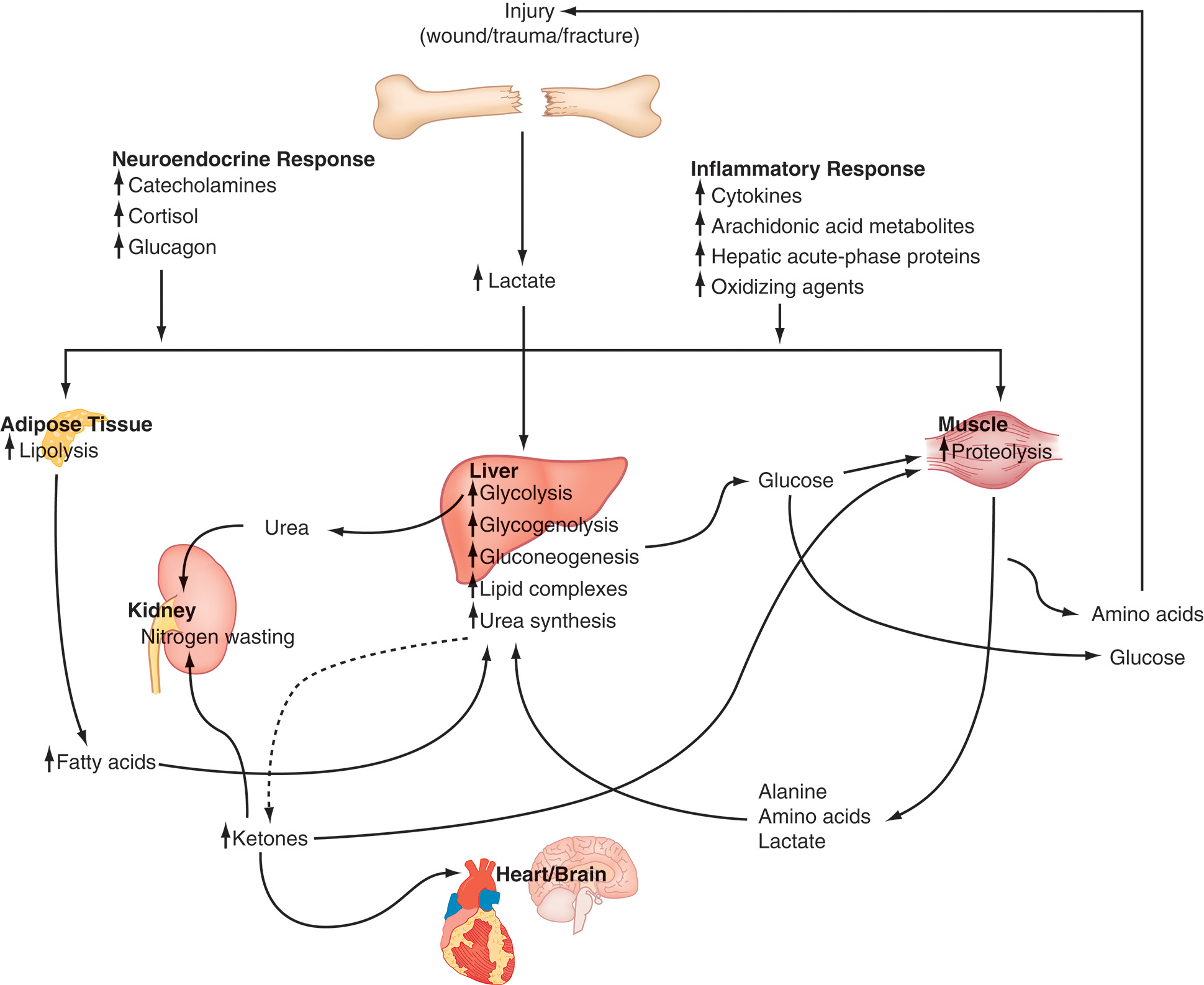 A schematic diagram showing how burns change metabolism, increasing fat breakdown, protein loss, and glucose production through hormonal and immune signals. The diagram depicts how injury changes metabolism in multiple organs. At the top center, a broken bone labeled injury, with the words wound, trauma, and fracture in parentheses, represents tissue damage. A downward arrow from the fractured bone points to the word lactate, indicating that injury directly increases lactate production in the body. From this central point, arrows extend to two major pathways: the neuroendocrine response on the left and the inflammatory response on the right. The neuroendocrine response increases catecholamines, cortisol, and glucagon. The inflammatory response increases cytokines, arachidonic acid metabolites, hepatic acute-phase proteins, and oxidizing agents. Both raise lactate production. Adipose tissue on the left shows lipolysis producing fatty acids. The muscle on the right shows proteolysis producing amino acids, alanine, and lactate. The liver in the center increases glycolysis, glycogenolysis, gluconeogenesis, lipid complex formation, and urea synthesis. The kidney below shows nitrogen wasting and ketone formation. The heart and brain at the bottom use ketones as an energy source. Arrows connect the organs, showing glucose moving from the liver to the muscle, amino acids and lactate returning to the liver, and urea moving from the liver to the kidney.