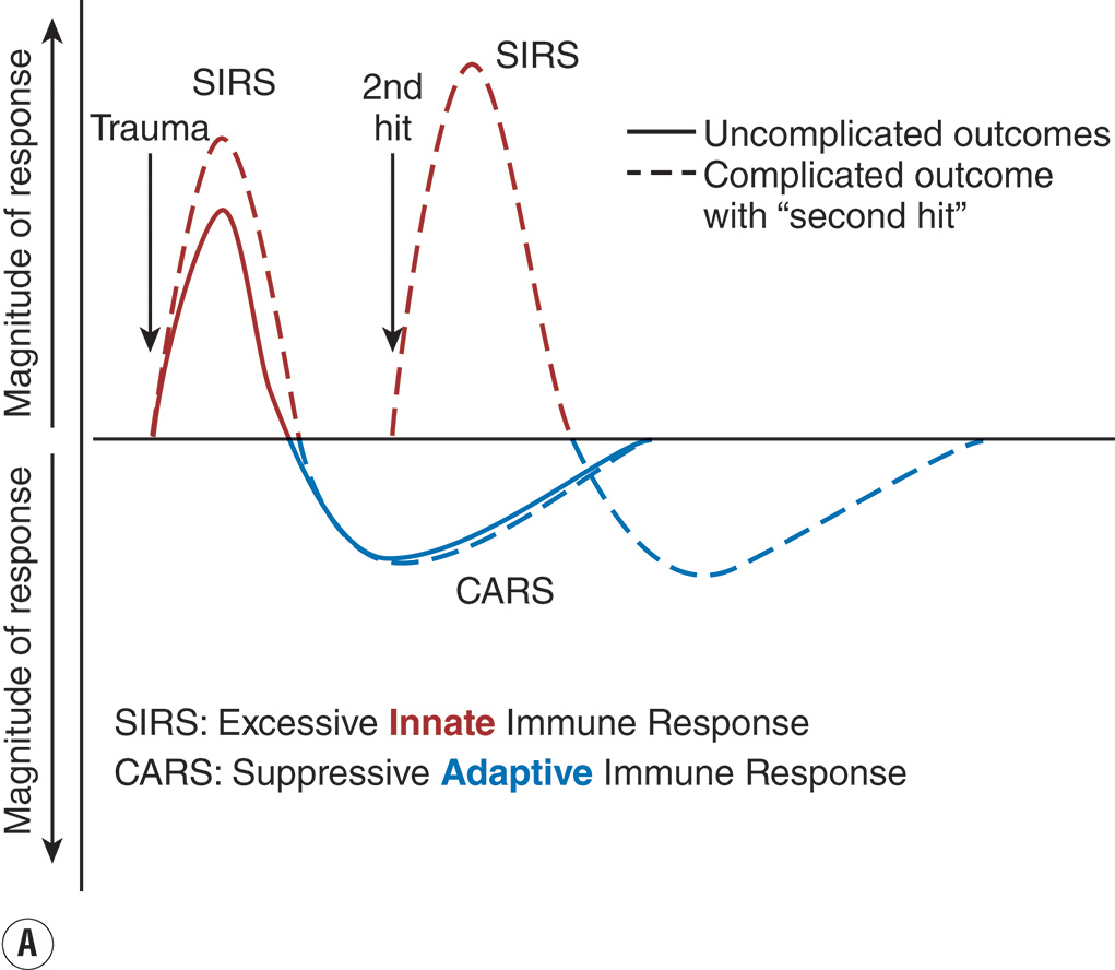 A two-part line graph comparing the magnitude of the immune response after trauma. The view includes two graphs labeled A and B. Part A graph plots the magnitude of response on the vertical axis and time after trauma on the horizontal axis. Two curves are labeled S I R S for excessive innate response and C A R S for suppressive adaptive response. The S I R S curve rises sharply, then drops below baseline before the C A R S curve forms a shallow trough. A dashed line shows a complicated outcome with a second hit, and a solid line shows an uncomplicated outcome. Part B graph is titled dysregulated innate immune response and dysregulated adaptive immune response. Magnitude of response is on the y-axis and time after trauma on the x-axis. The upper curve, labeled innate immune response, peaks early and declines gradually. The lower curve labeled adaptive immune response rises later and stabilizes below baseline.