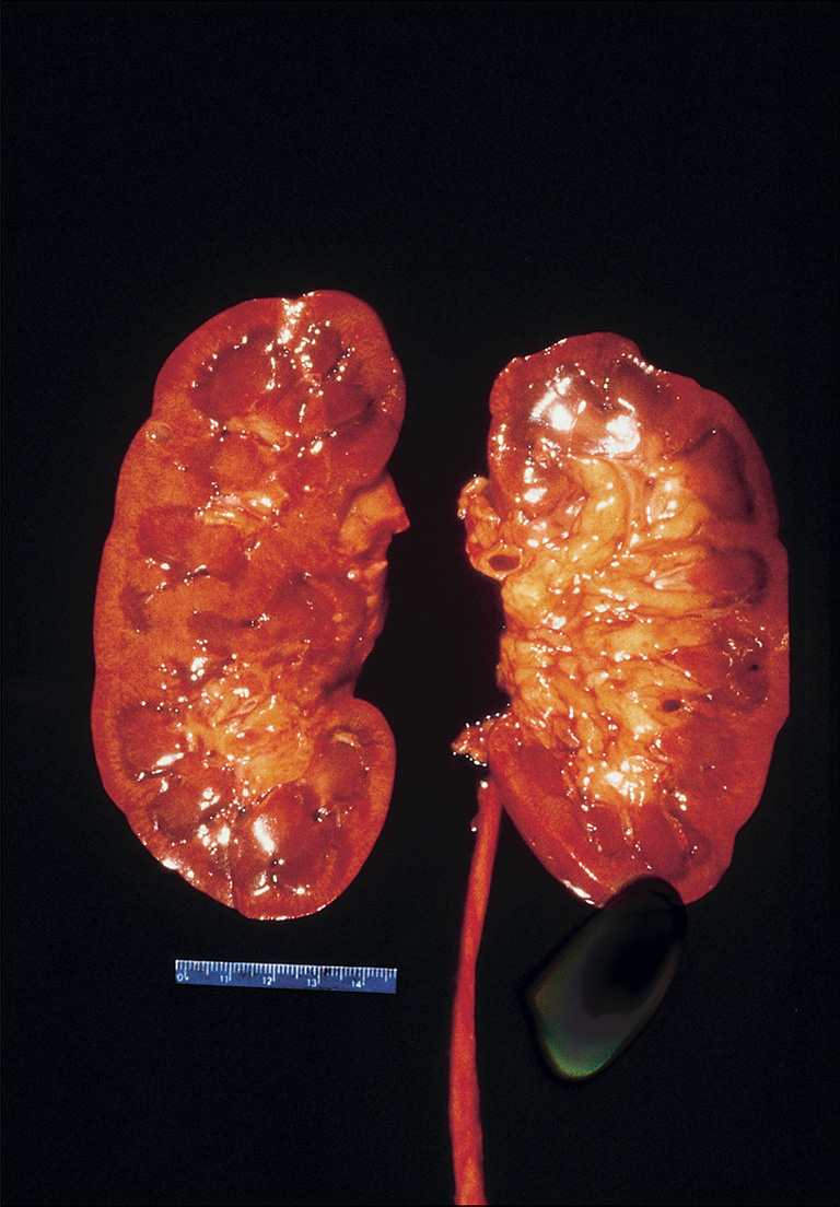 A gross view of the kidneys shows marked swelling, surface irregularity, and pale medullary pyramids with a tubular ureter segment extending downward from the kidney on the right side of the view.