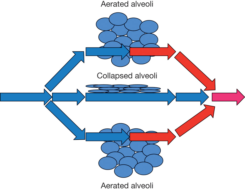 An illustration shows airflow in aerated and collapsed alveoli, with blue arrows indicating normal airflow and red arrows representing forced airflow to re-expand collapsed alveoli. The illustration shows the airflow in the lungs, specifically focusing on aerated and collapsed alveoli. The blue arrows indicate the normal flow of air into the aerated alveoli. In contrast, the red arrows represent the forced airflow directed towards collapsed alveoli to re-expand them. The diagram highlights the difference in airflow dynamics between well-aerated and collapsed alveoli, emphasizing the efforts to restore proper lung function in cases of alveolar collapse. The pink arrow shows the overall direction of airflow, suggesting the goal of re-expanding the collapsed areas.