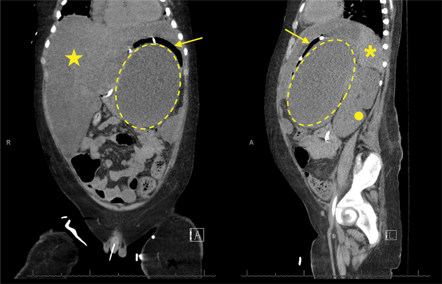 A coronal and sagittal C T scans of a large pancreatic pseudocyst (dotted outline) causing mass effect. Hepatomegaly (star), stomach (arrow), spleen (asterisk), and left kidney (circle) are labeled. The two computed tomography scan views of coronal on the left, sagittal on the right of the upper abdomen, highlighting a large pancreatic pseudocyst marked by a dotted outline. The mass effect of the cyst is evident, displacing adjacent organs. Other labeled findings include hepatomegaly, indicating an enlarged liver, marked by a star on both scans. The stomach is indicated by an arrow, the spleen by an asterisk, and the left kidney is marked by a circle on the sagittal view.