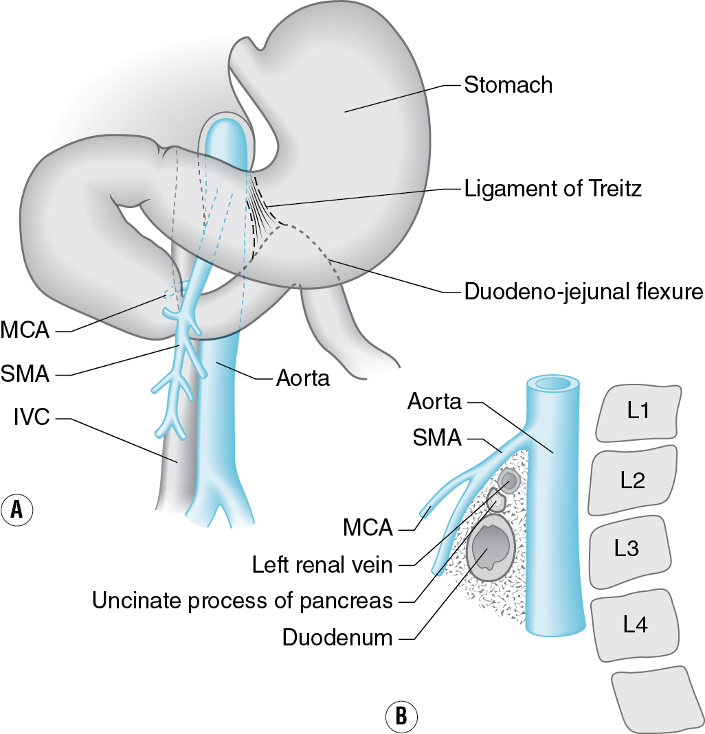 A schematic diagram showing the mechanism of Superior Mesenteric Artery S M A Syndrome, where the S M A compresses the third portion of the duodenum against the aorta. The two schematic illustrations detail the vascular compression in the Superior Mesenteric Artery S M A Syndrome. Diagram A shows an anterior view of the upper abdomen where the Superior Mesenteric Artery S M A and the Middle Colic Artery M C A branch off the Aorta. The Inferior Vena Cava I V C is also shown. The third portion of the duodenum is compressed between the S M A and the Aorta near the Ligament of Treitz and Duodeno-jejunal flexure. Diagram B provides a cross-sectional view of the lumbar spine level L 1 to L 4, emphasizing the narrow angle created by the Aorta and S M A as they pass anteriorly, compressing the third portion of the duodenum and the left renal vein over the uncinate process of the pancreas and the spine.