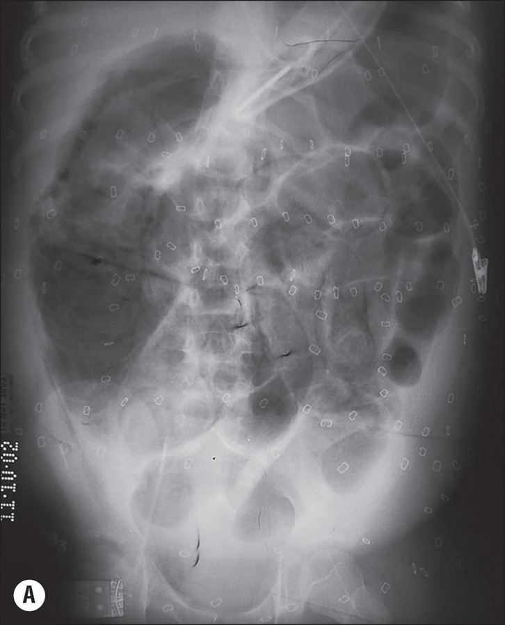 A radiograph A showing dilated, fixed bowel loops, and a corresponding surgical view B of necrotic bowel in a case of Necrotizing Enterocolitis. The two views illustrating Necrotizing Enterocolitis N E C. Radiograph A is an abdominal radiograph showing multiple, severely dilated, and persistently fixed bowel loops, which is a sign suggesting full-thickness necrosis. Photograph B is an intraoperative photograph showing the same patient's small bowel, confirming the diagnosis with clear evidence of multiple necrotic bowel segments. The affected segments appear discolored and inflamed next to healthier tissue.