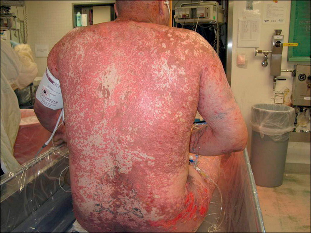A close-up of a severe chemical burn, Epichlorohydrin, on a patient's back, 3 days post-admission, with inflamed, scattered areas of slough skin. Medical tubing and a blood pressure cuff are shown.