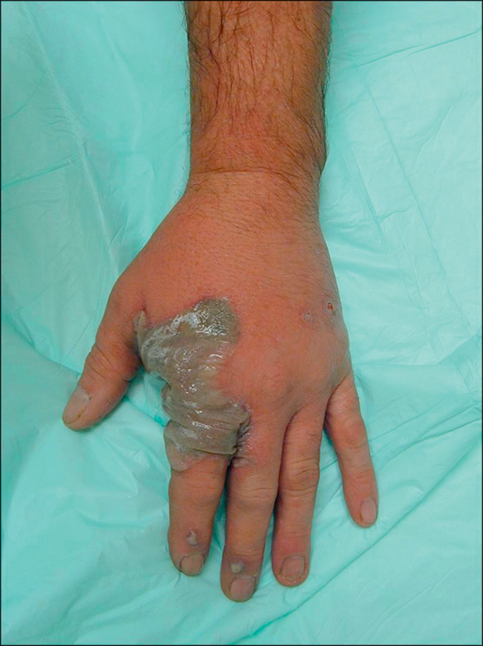 A dorsal view of a hand with a deep Hydrochloric acid chemical burn before blister removal. A large, intact, pus-filled blister covers the proximal phalanges of the index and middle fingers.