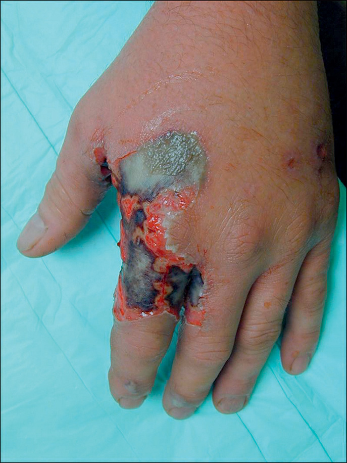 A post-debridement view of a Hydrochloric acid chemical burn on the dorsal hand after blister removal exposes a deep, raw wound with underlying necrotic tissue, bordered by inflamed skin.