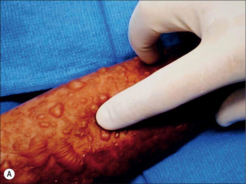 A three-part photograph labeled A to C shows Nikolsky’s sign, with gentle lateral pressure producing separation of the superficial epidermis on the forearm. The three-part photograph shows a gloved index finger applying gentle lateral pressure to patterned, blister-prone skin on a forearm in Part A; in Part B, the epidermis peels away as a fragile sheet under the finger, and in Part C, a superficial area of epidermal detachment is seen, exposing a moist, raw surface.