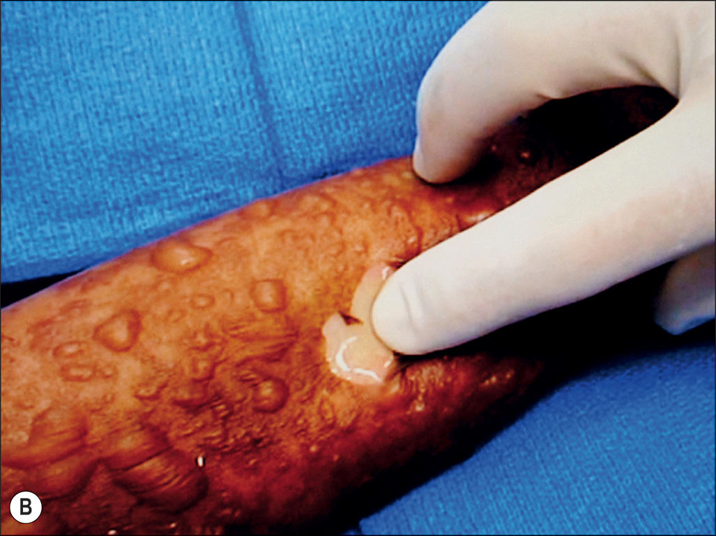 A three-part photograph labeled A to C shows Nikolsky’s sign, with gentle lateral pressure producing separation of the superficial epidermis on the forearm. The three-part photograph shows a gloved index finger applying gentle lateral pressure to patterned, blister-prone skin on a forearm in Part A; in Part B, the epidermis peels away as a fragile sheet under the finger, and in Part C, a superficial area of epidermal detachment is seen, exposing a moist, raw surface.