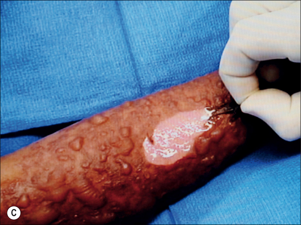 A three-part photograph labeled A to C shows Nikolsky’s sign, with gentle lateral pressure producing separation of the superficial epidermis on the forearm. The three-part photograph shows a gloved index finger applying gentle lateral pressure to patterned, blister-prone skin on a forearm in Part A; in Part B, the epidermis peels away as a fragile sheet under the finger, and in Part C, a superficial area of epidermal detachment is seen, exposing a moist, raw surface.