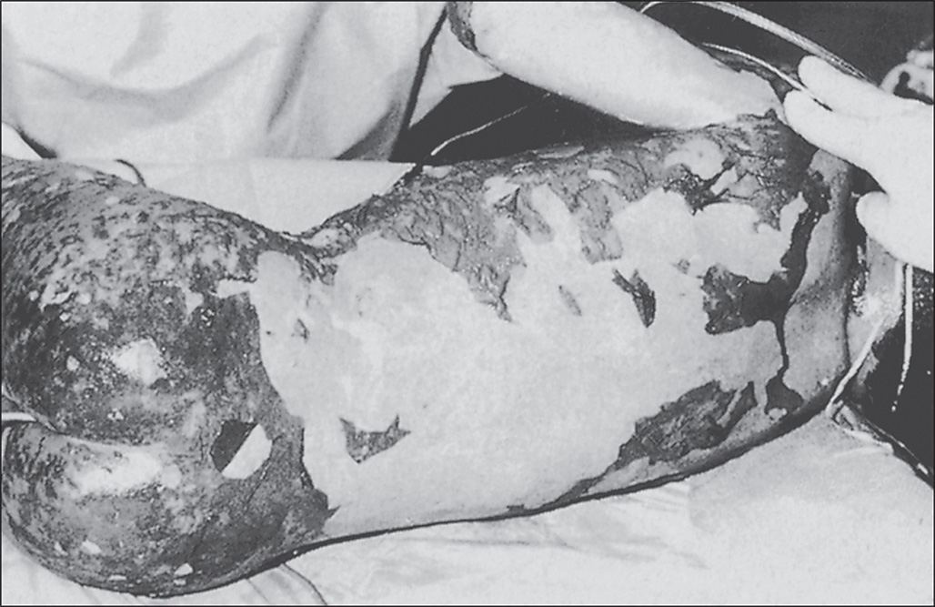 A photograph shows a large body surface area of epidermal detachment with irregular, peeled-away skin borders and residual patches of adherent epidermis.